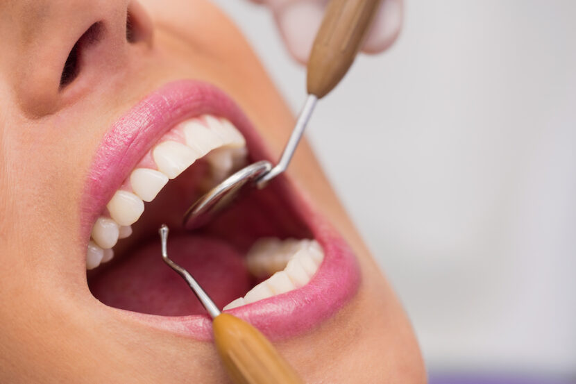 Impianti dentali: ritrova il tuo sorriso